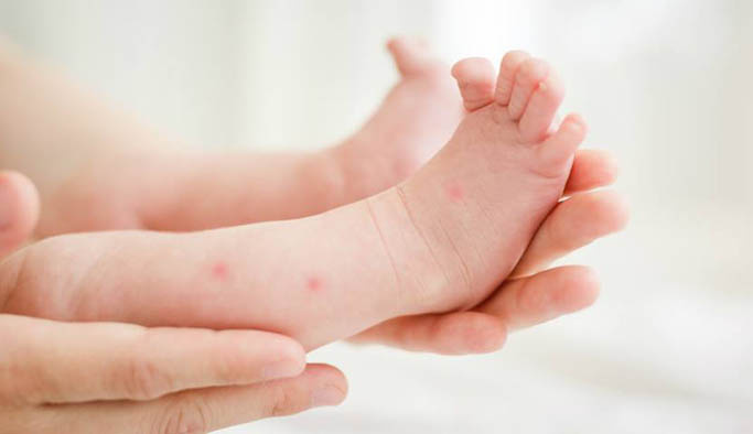 Bebeklerde sinek ısırığı zararlı mı ne yapmak gerekir